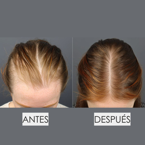 Parches Capilares Anticaida TricoVIT